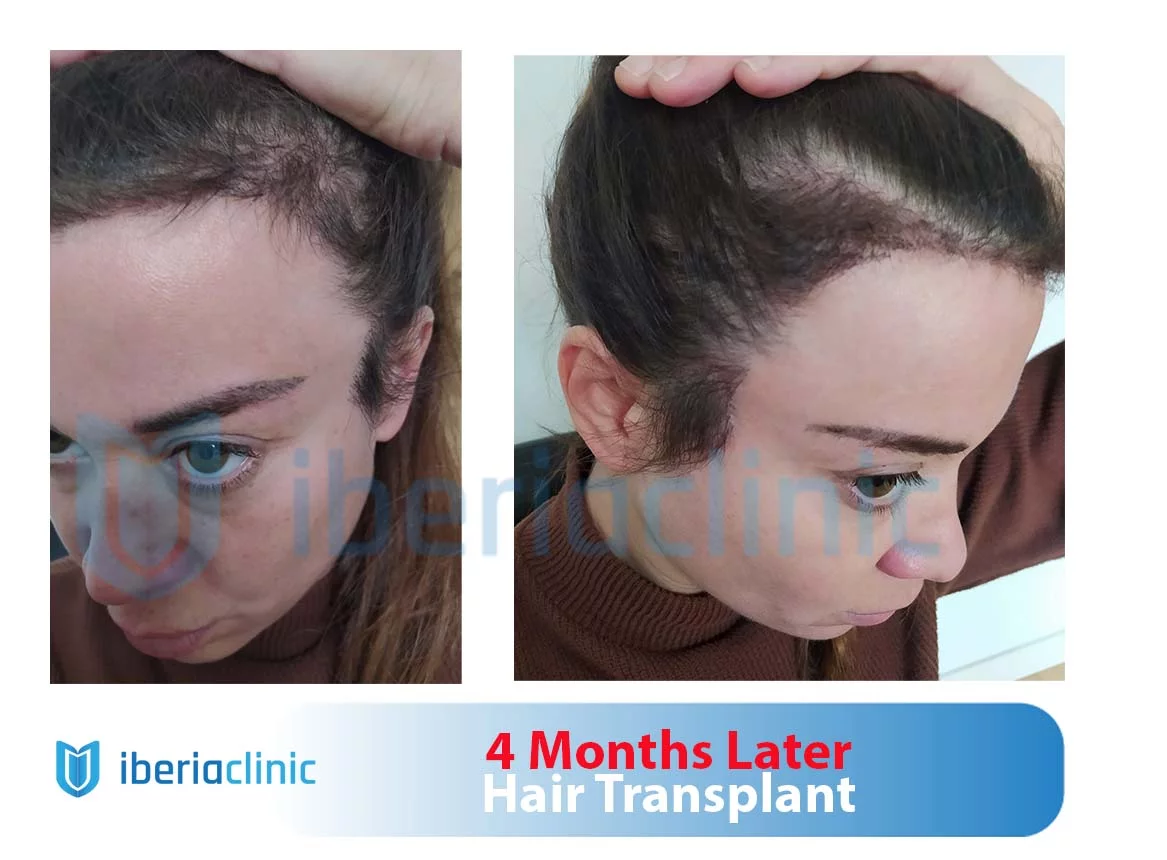 Before and After Photos of Hair Transplant Surgeries  what success and  failure look like