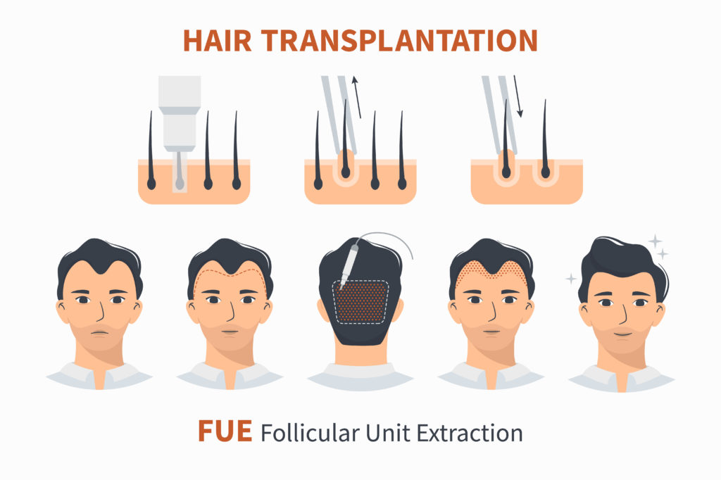 FUE Hair Transplantation