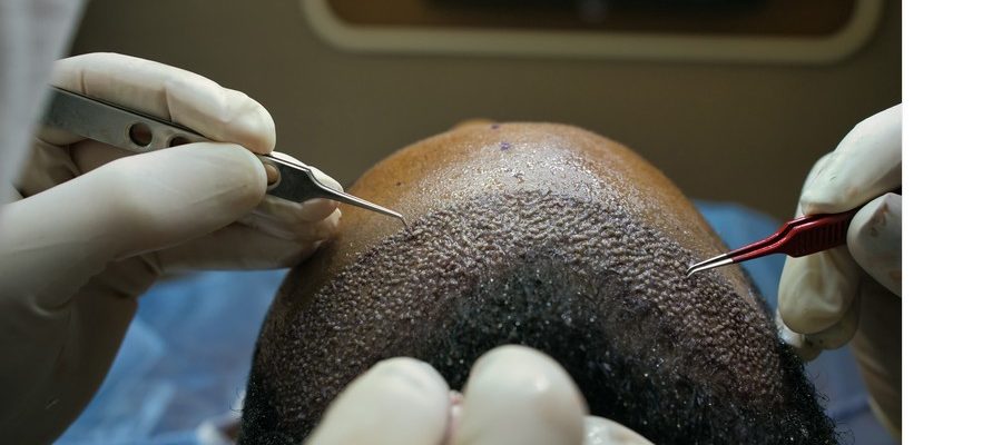 How Long Do I Have To Stay in Turkey for a Hair Transplant? - İberia Clinic