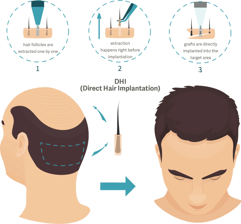 DHI Hair Transplant - İberia Clinic
