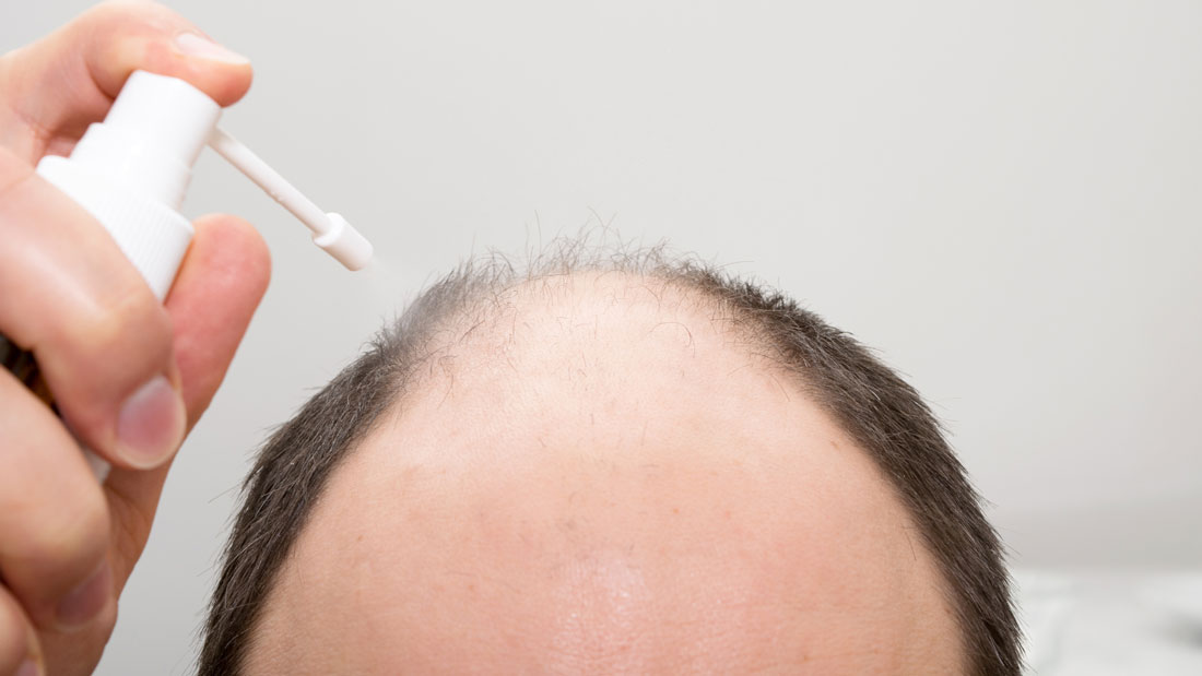 What is Androgenetic Alopecia? - İberia Clinic